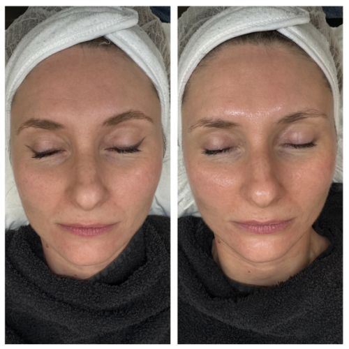 Soins traitants de la peau - Institut de beauté à Grésy sur Aix