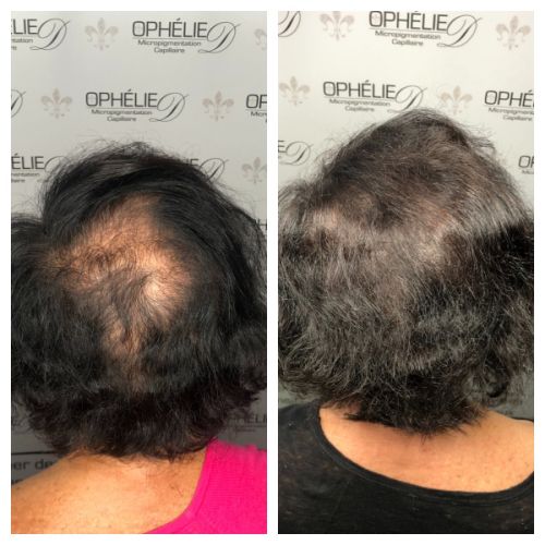 Tricopigmentation à Grésy sur Aix ODB Concept