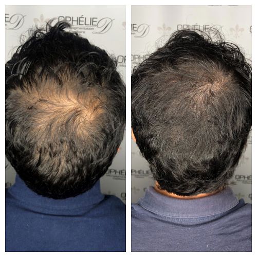 Tricopigmentation à Grésy sur Aix ODB Concept