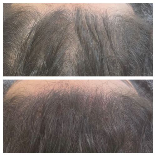 Tricopigmentation à Grésy sur Aix ODB Concept