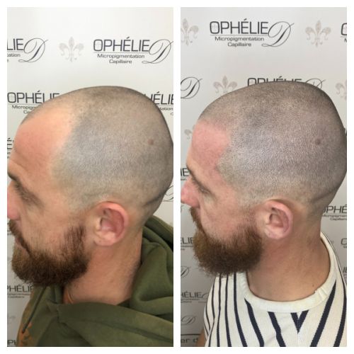 Tricopigmentation à Grésy sur Aix ODB Concept