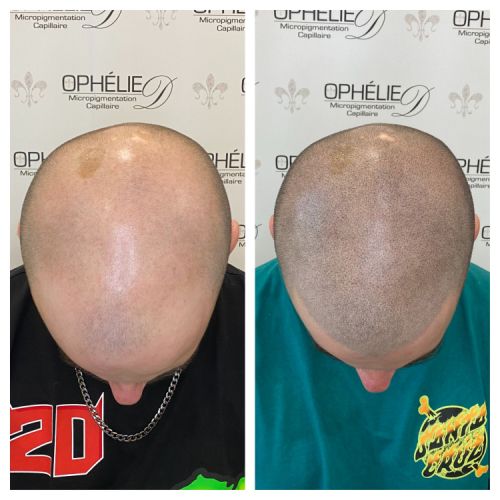 Tricopigmentation à Grésy sur Aix ODB Concept