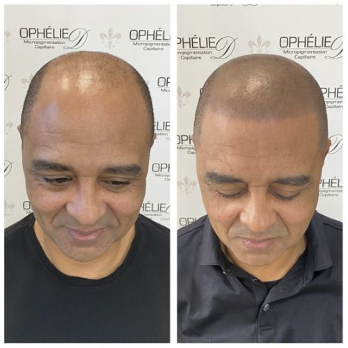 Tricopigmentation à Grésy sur Aix ODB Concept