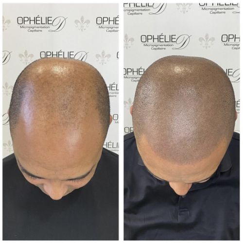 Tricopigmentation à Grésy sur Aix ODB Concept