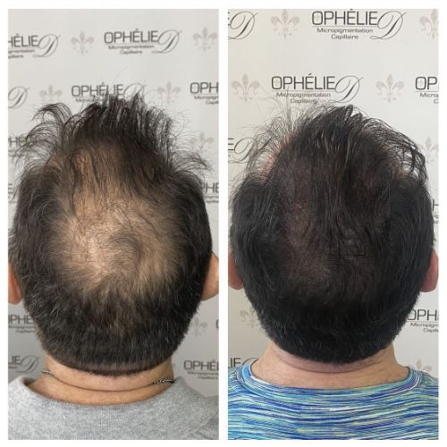 Tricopigmentation à Grésy sur Aix ODB Concept