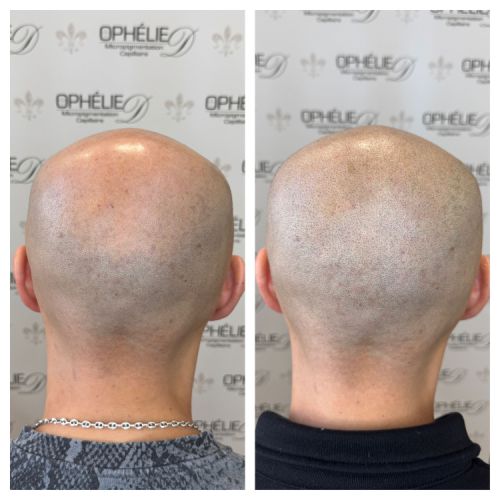 Tricopigmentation à Grésy sur Aix ODB Concept