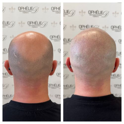 Tricopigmentation à Grésy sur Aix ODB Concept