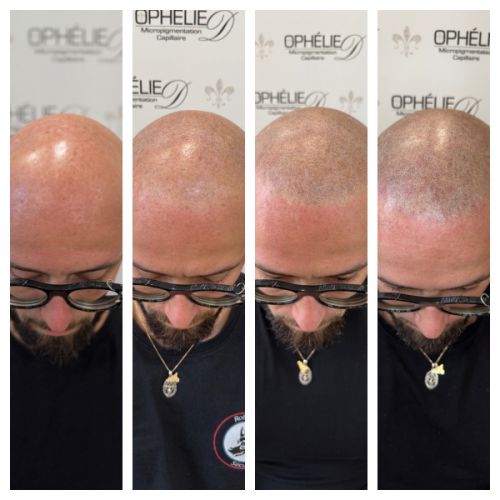 Tricopigmentation à Grésy sur Aix ODB Concept