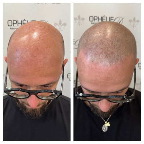 Tricopigmentation à Grésy sur Aix ODB Concept