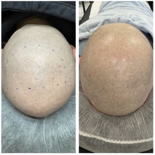 Tricopigmentation à Grésy sur Aix ODB Concept