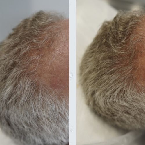 Tricologie - ODB Concept salon de coiffure à Grésy sur Aix