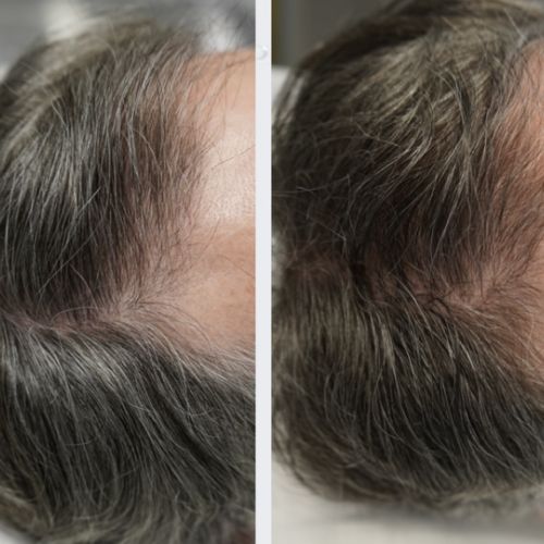 Tricologie - ODB Concept salon de coiffure à Grésy sur Aix