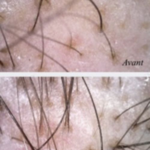 Tricologie - ODB Concept salon de coiffure à Grésy sur Aix