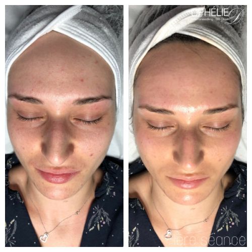 Soins traitants de la peau - Institut de beauté à Grésy sur Aix