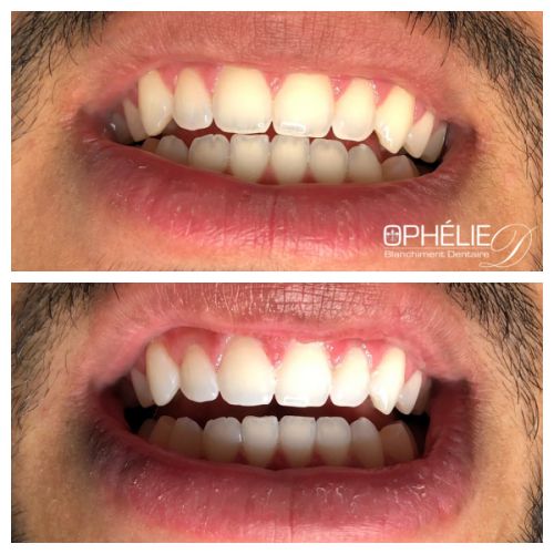 Blanchiment dentaire à Grésy Sur Aix - ODB Concept