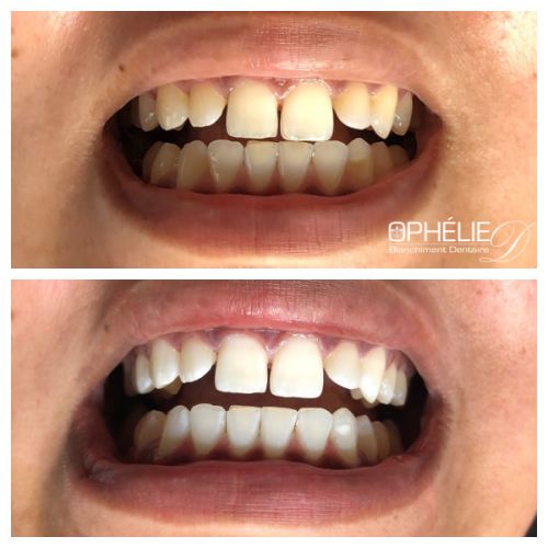 Blanchiment dentaire à Grésy Sur Aix - ODB Concept