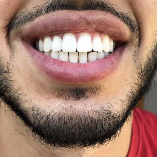 Blanchiment dentaire à Grésy Sur Aix - ODB Concept