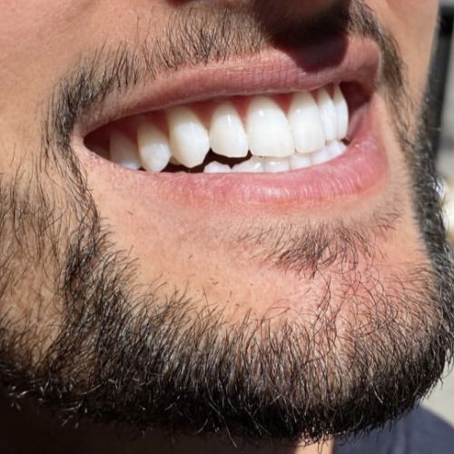 Blanchiment dentaire à Grésy Sur Aix - ODB Concept