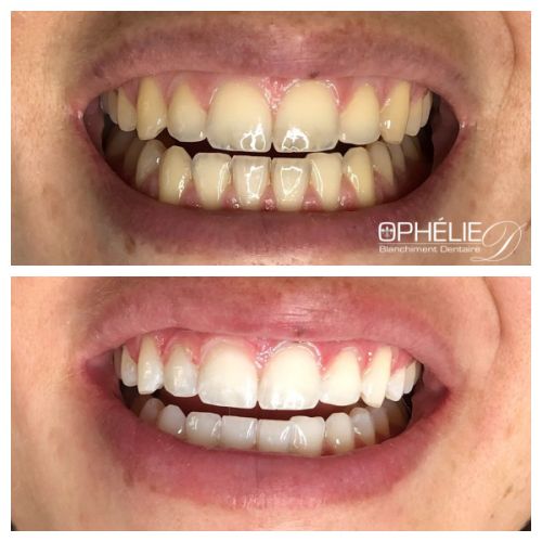 Blanchiment dentaire à Grésy Sur Aix - ODB Concept