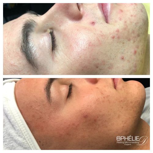 Soins traitants de la peau - Institut de beauté à Grésy sur Aix