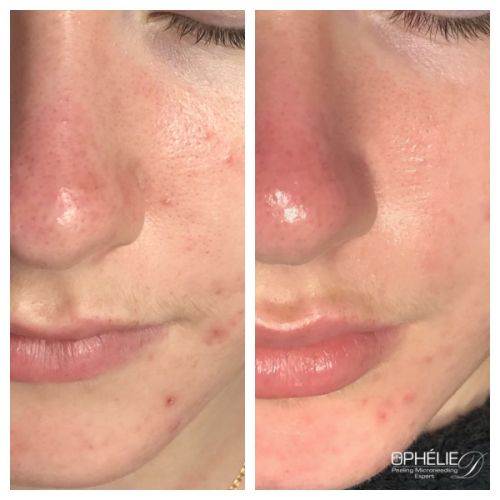 Soins traitants de la peau - Institut de beauté à Grésy sur Aix