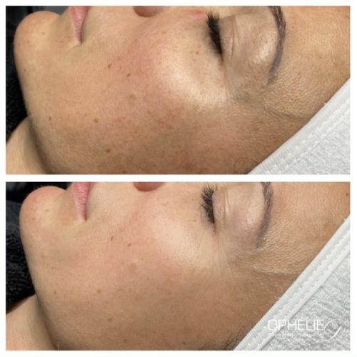 Soins traitants de la peau - Institut de beauté à Grésy sur Aix