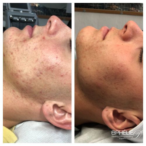 Soins traitants de la peau - Institut de beauté à Grésy sur Aix